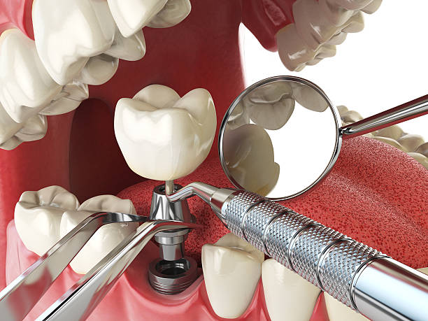 Best Emergency Tooth Extraction in Colton, CA